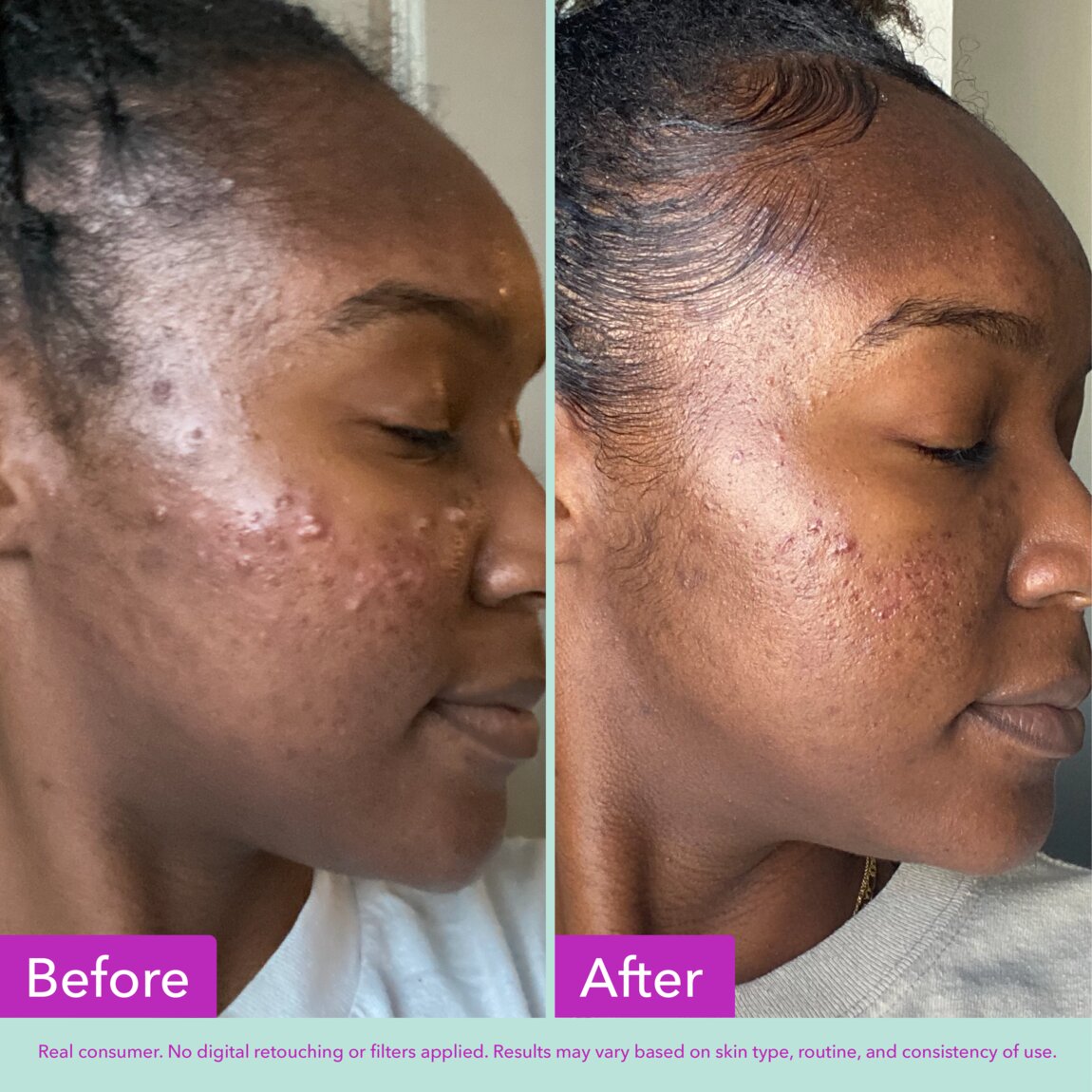 acne-foaming-cleanser-c0 zb_p.jpg