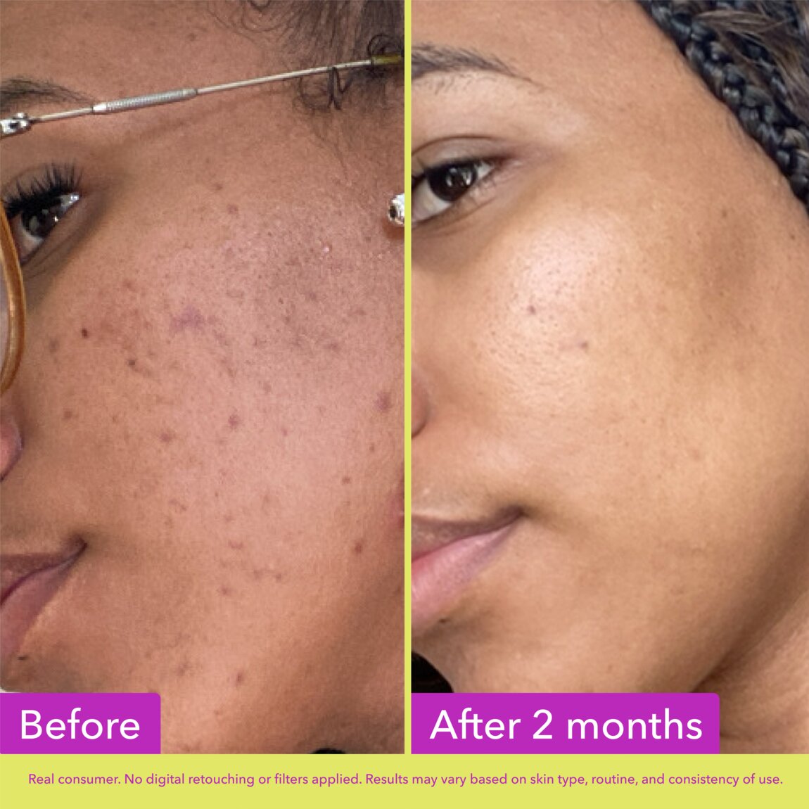 10-azelaic-acid-treatment-q2 zb_p.jpg